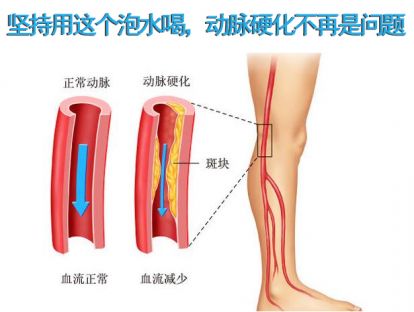 坚持用这个泡水喝，动脉硬化不再是问题