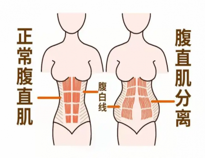 腹直肌为什么会分离