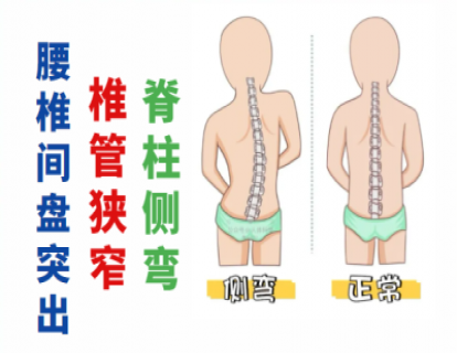 极易针灸治疗脊柱侧弯