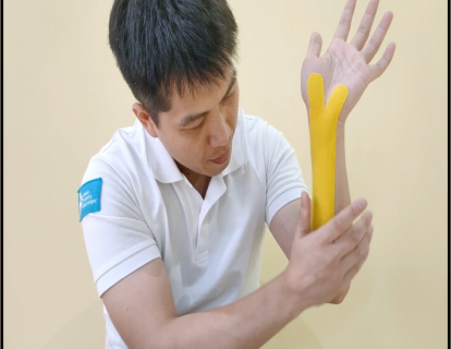 腕管综合征的贴扎