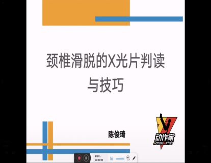 颈椎滑脱的X光片判读与技巧