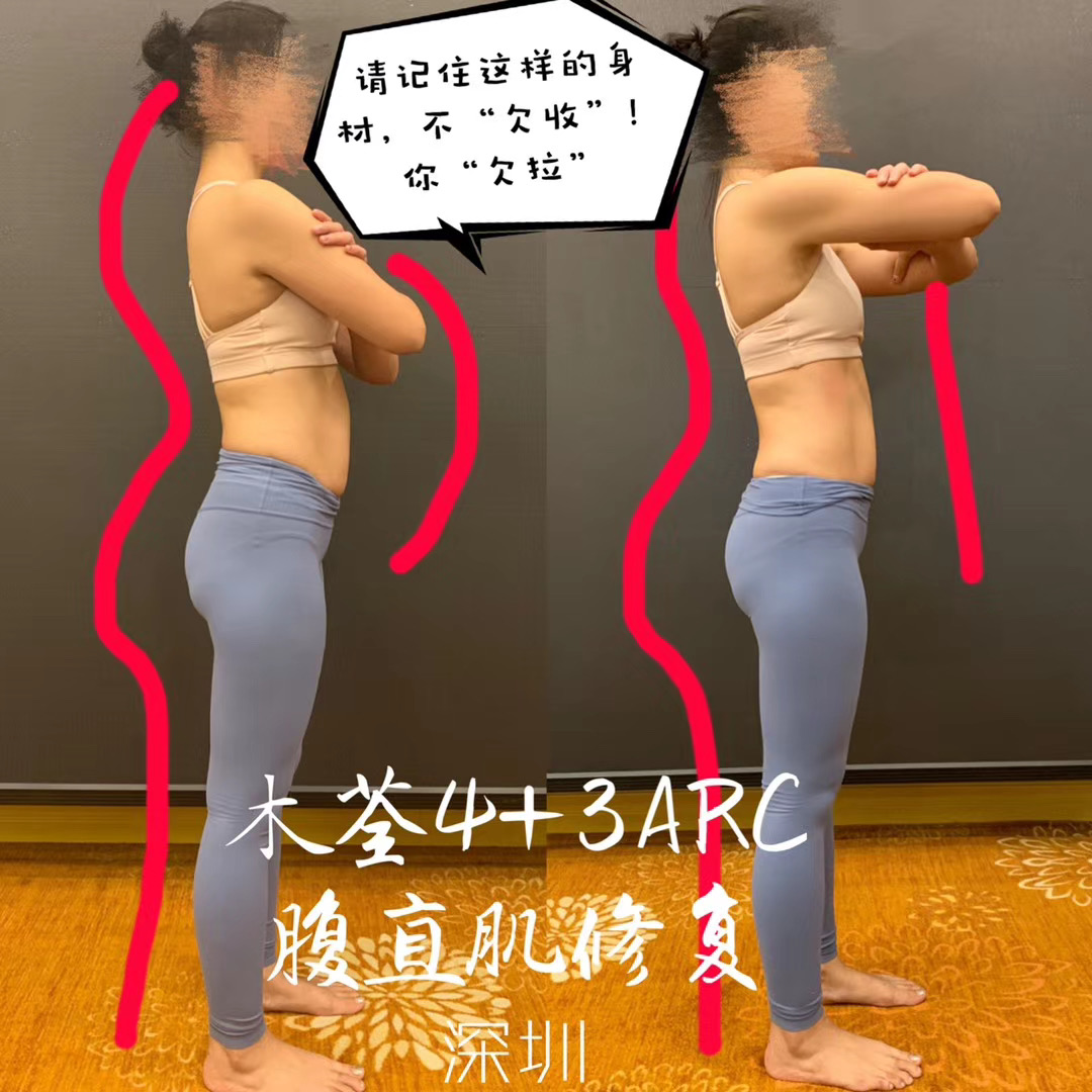 腹直肌分离?不要再收收收了!50+颠覆产后瑜伽圈的松解、激活与训练,别再上智商税了!