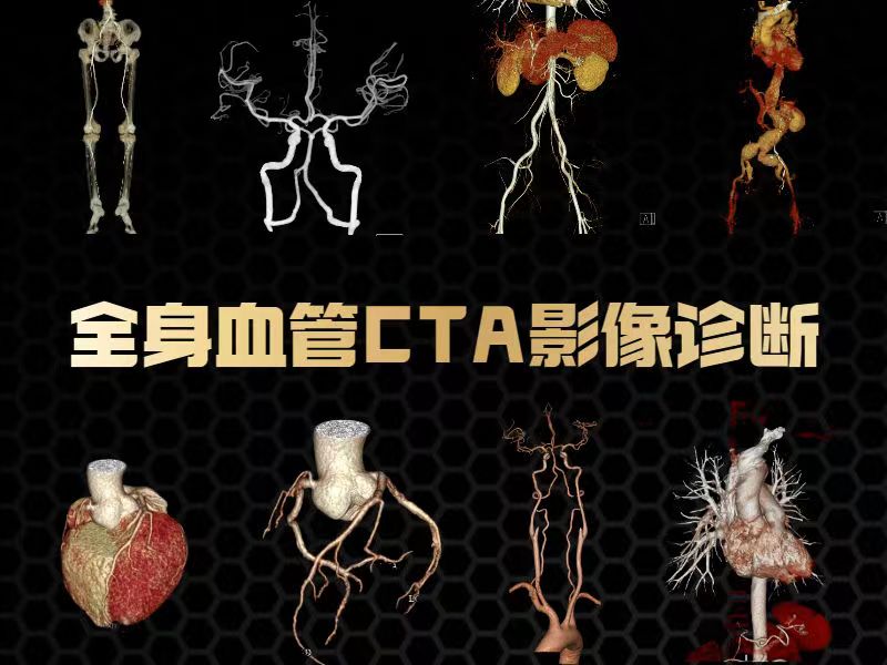 【循环】全身血管CTA影像诊断