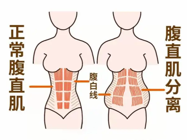 腹直肌修复